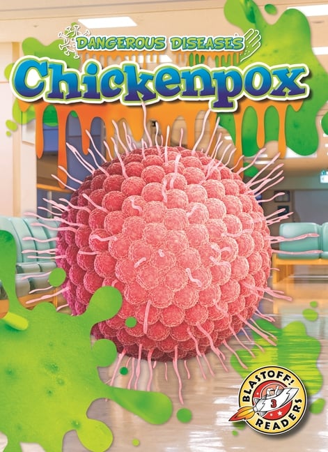 Chicken Pox
